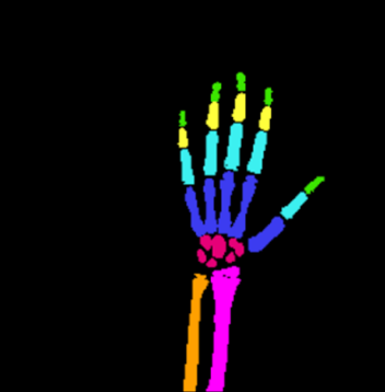 Fracture Detection XAI